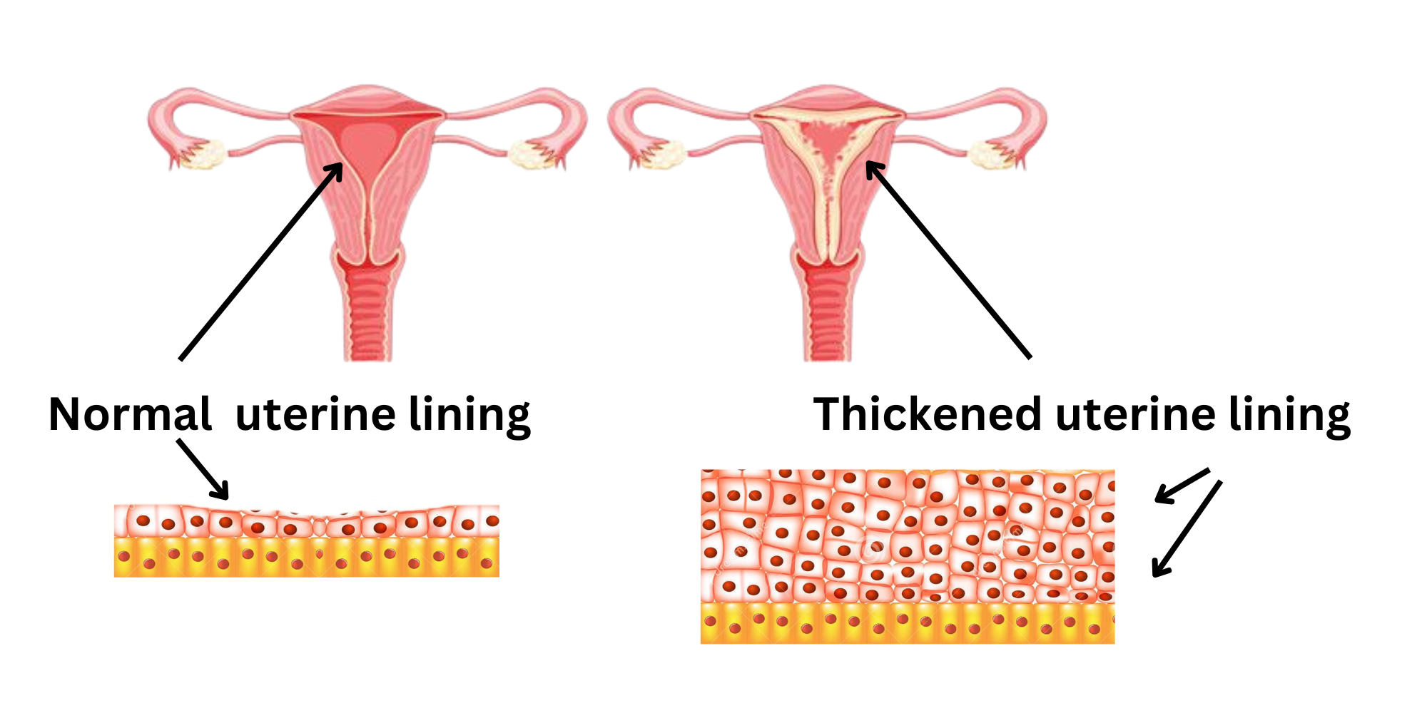 What Is A Normal Uterine Lining Measurement